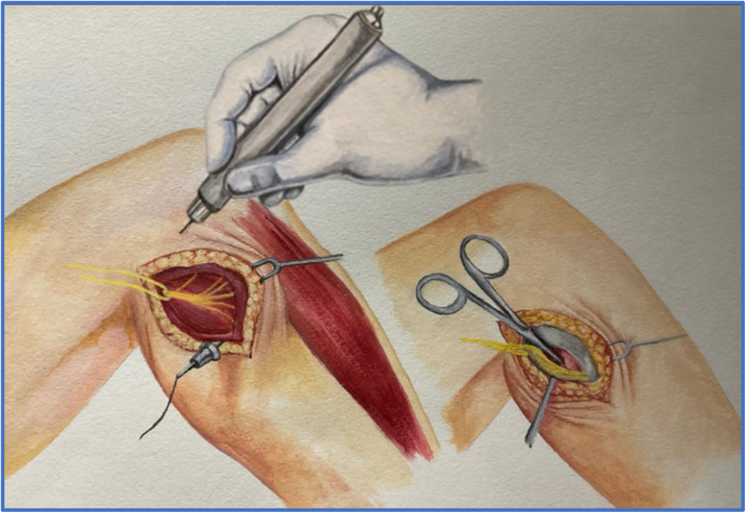 Denervation of the Proximal Tibiofibular Joint