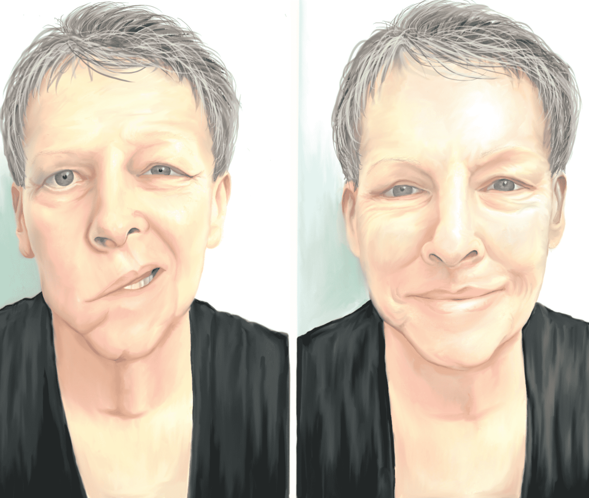 Facial Paralysis Illustration