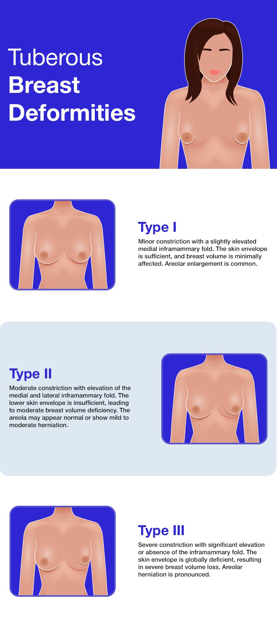 IFAR - Tuberous Breast Deformities 03-20-25