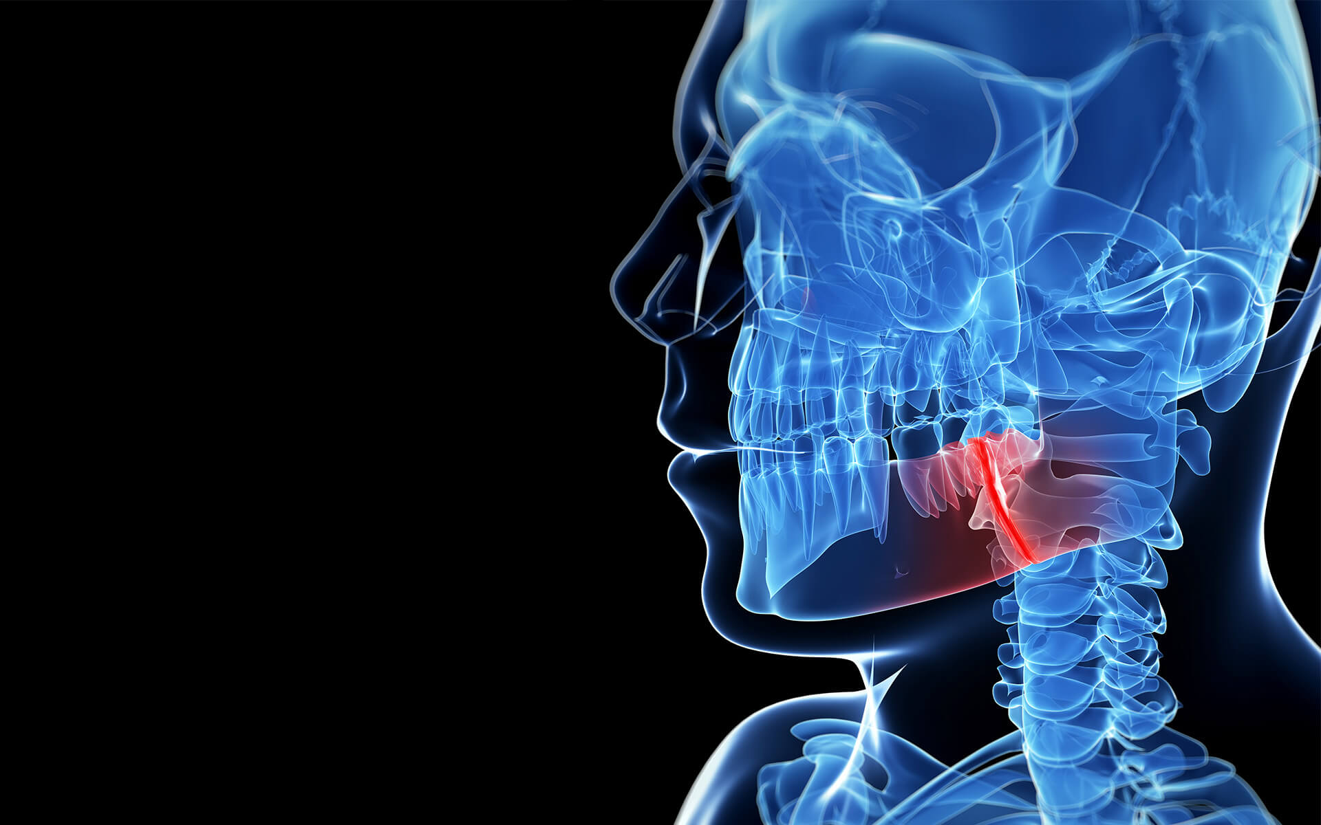 tmj-headache