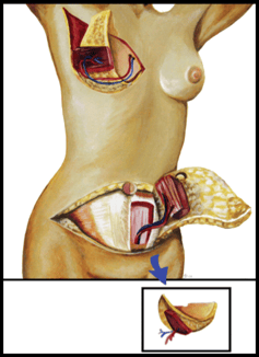 Breast Reconstruction at The Institute for Advanced Reconstruction