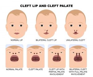 cleft lip and cleft palate