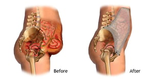 BARs Hernia Treatment