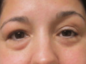 Before Orbital Decompression