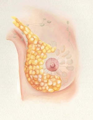 Stage IV