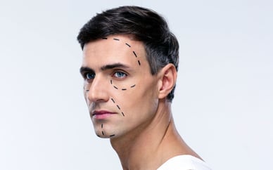male face surgery markers