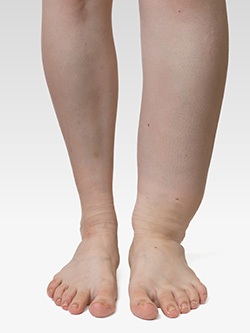 lymphedema-leg